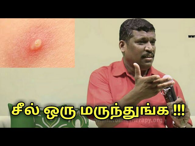 சீல் பிடித்தால் நல்லதுங்க | Healer baskar