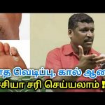 பாத வெடிப்பு,கால் ஆணி குணமாக | Foot cracks and Toe nail treatment by Healer Baskar