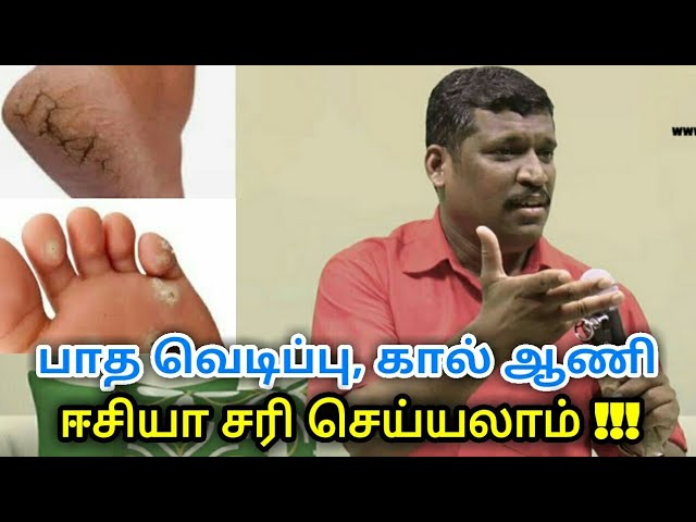 பாத வெடிப்பு,கால் ஆணி குணமாக | Foot cracks and Toe nail treatment by Healer Baskar
