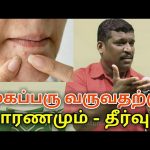 முகப்பரு குணமாக ஈசியான இயற்கை வழி | Pimples treatment by Healer baskar