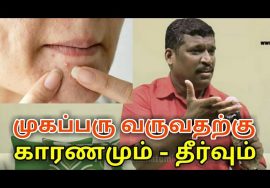 முகப்பரு குணமாக ஈசியான இயற்கை வழி | Pimples treatment by Healer baskar