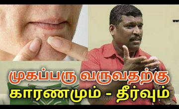 முகப்பரு குணமாக ஈசியான இயற்கை வழி | Pimples treatment by Healer baskar