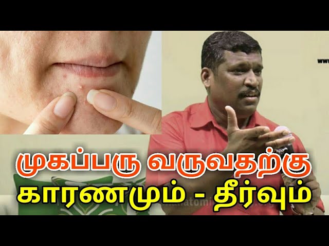 முகப்பரு குணமாக ஈசியான இயற்கை வழி | Pimples treatment by Healer baskar