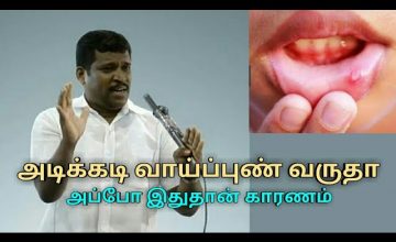 அடிக்கடி வாய்ப்புண் வர காரணம் இதுதான் | Healer baskar treatment on mouth ulcer