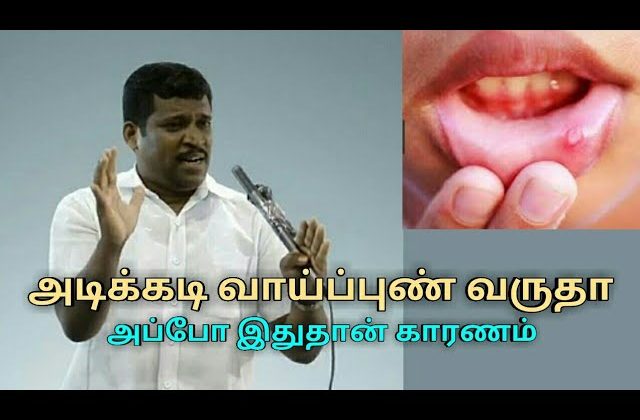 அடிக்கடி வாய்ப்புண் வர காரணம் இதுதான் | Healer baskar treatment on mouth ulcer