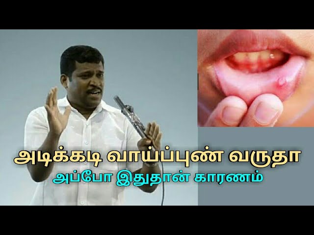 அடிக்கடி வாய்ப்புண் வர காரணம் இதுதான் | Healer baskar treatment on mouth ulcer
