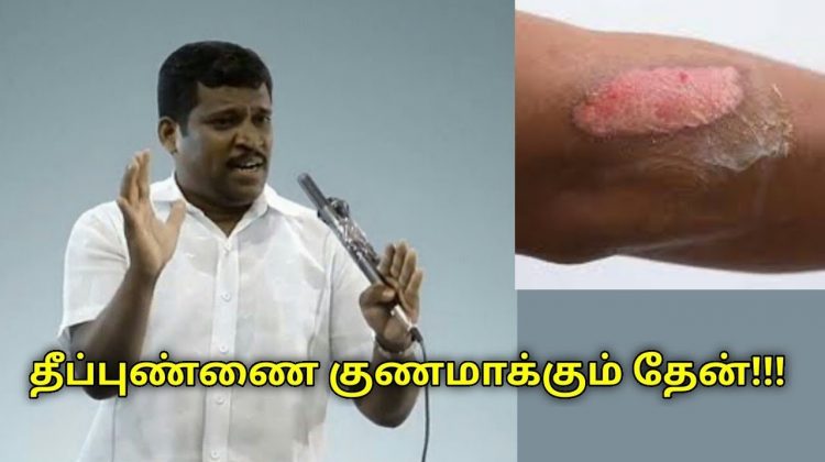 தீப்புண் குணமாக தேன் பூசுங்க | Healer Baskar speech on remedy for fire burns