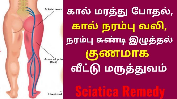 சியாட்டிகா என்னும் கால் நரம்பு வலி,கால் மரத்து போதல் குணமாக வீட்டு வைத்தியம் | Sciatica home remedy